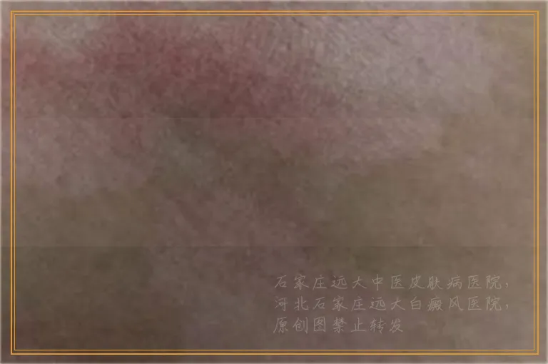 白癜风刚出现的图片