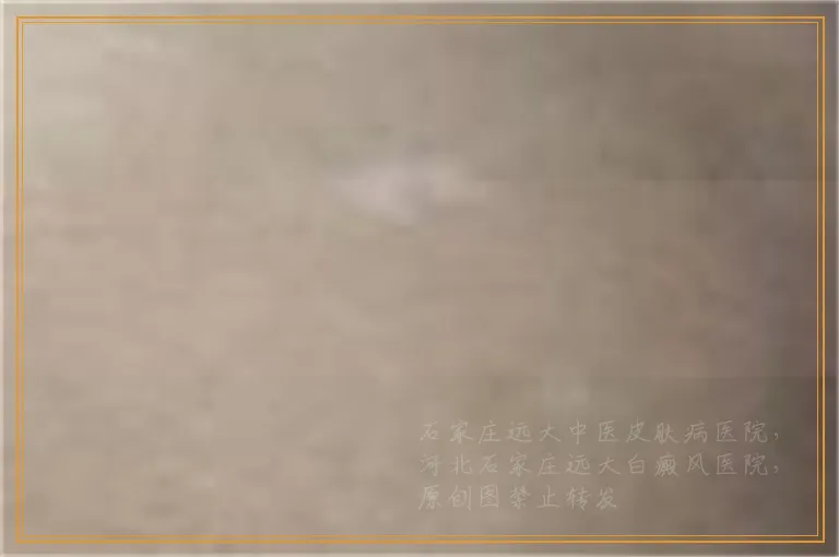 宝宝脸上出现两个白点怎么回事