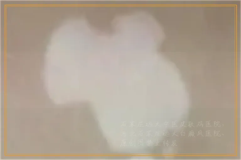 白斑出现在脸上会不会就是白癜风