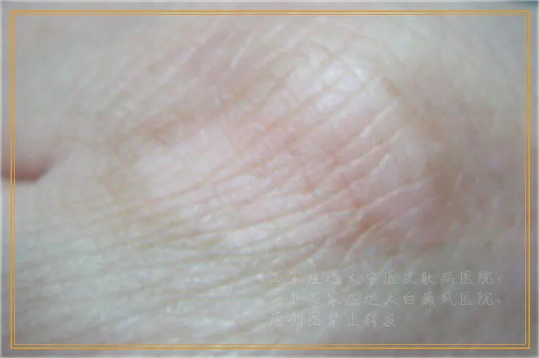 宝宝脸上起小白点的图片