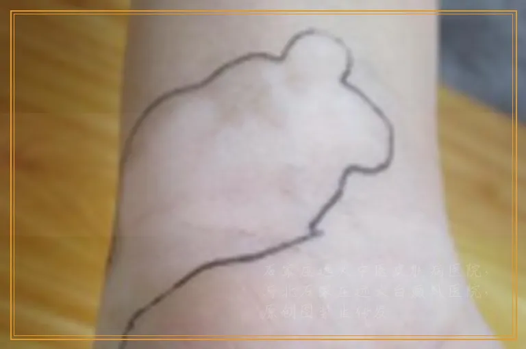 宝宝胳膊上出现一块白斑是什么原因