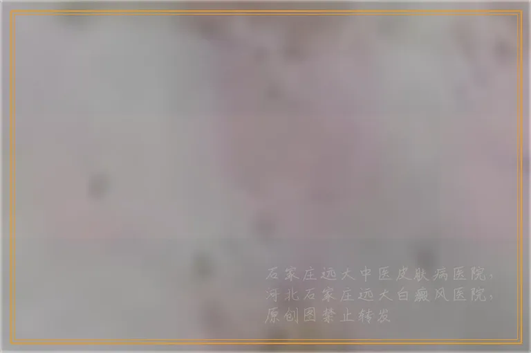 婴儿眉毛部位白一块是不是白癜风