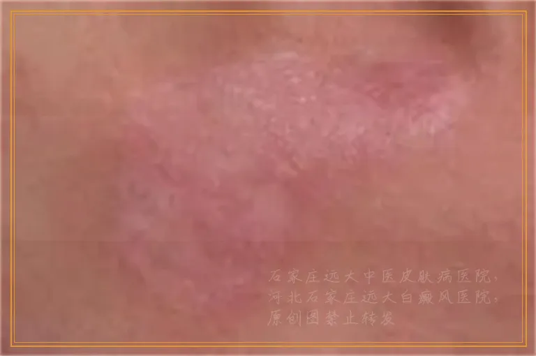 脸侧出现三个很明显的白斑怎么回事