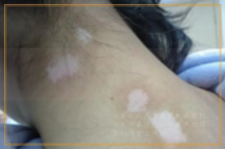 小孩脸部出现几块白斑怎么回事