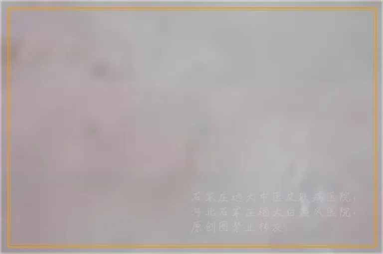 白癜风用药后出现什么症状表示有好转