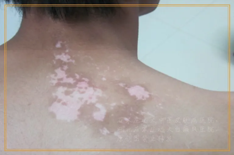 胳膊上的白癜风一直有新斑点出现怎么控制