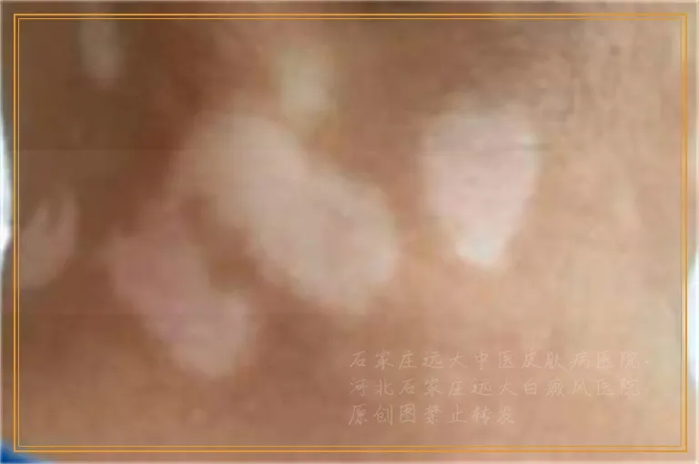 儿童脸上有一块白色怎么回事