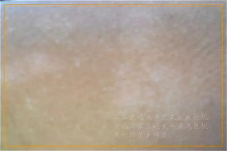 身上出现几块白斑是白癜风吗