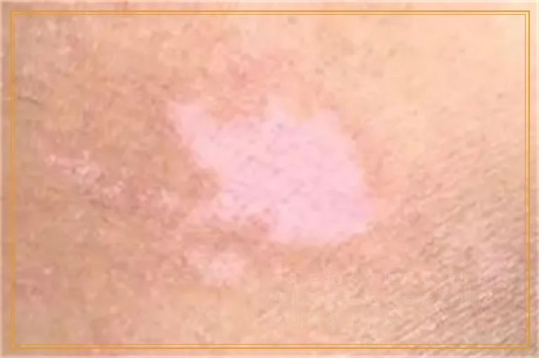 白癜风开始是小白点的样子吗