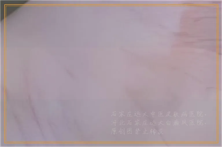 嘴角小白点会扩散到其他部位吗