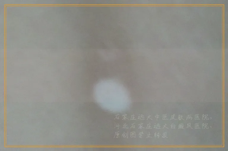 耳朵根上长几个小白点是白癜风吗