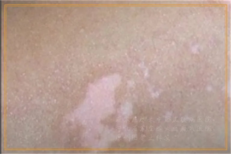 UVB照白癜风后出现红色是正常吗