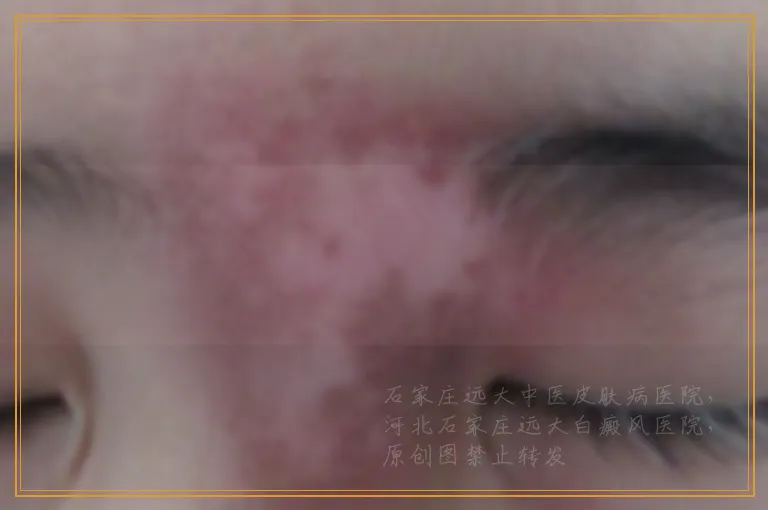 腿上有小白点是怎么回事