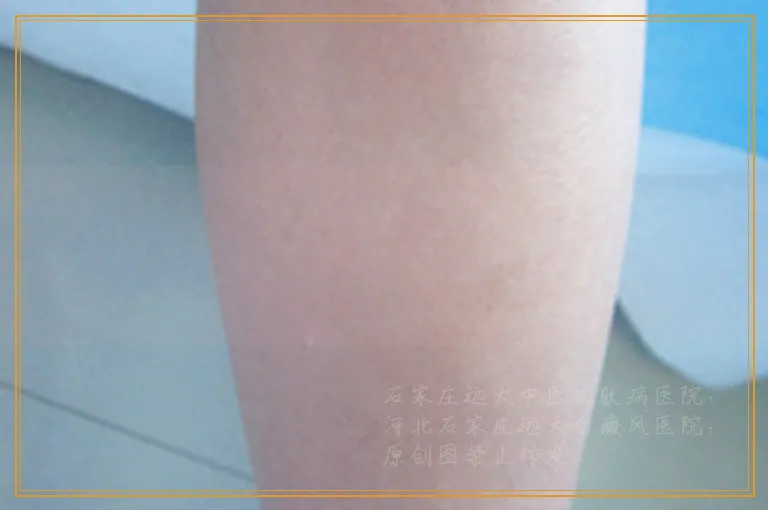 吃抗生素药身上出现小白点是怎么回事