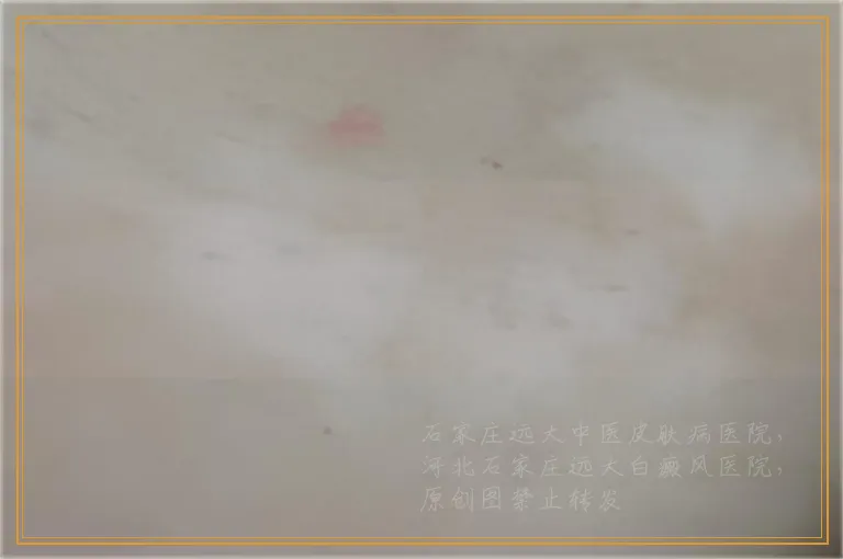 白癜风会从小白点一下大面积扩散吗