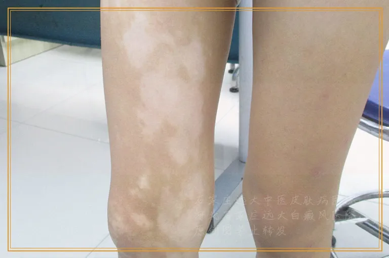 孕妇手臂出现一块白斑点是不是白癜风
