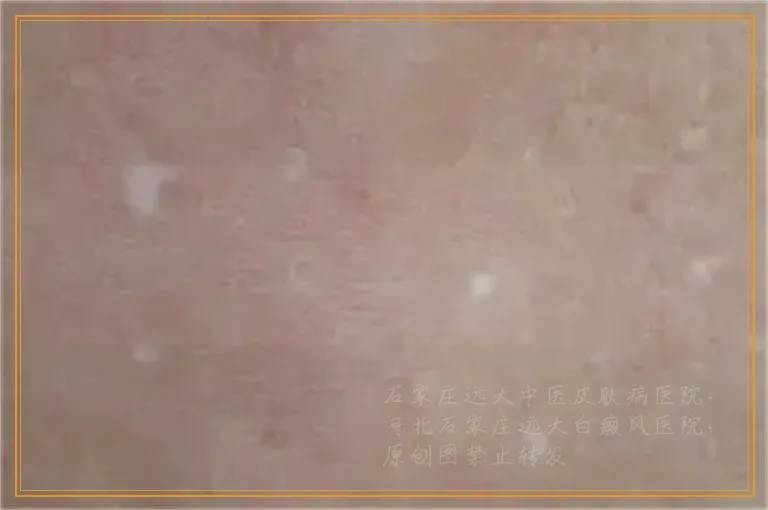皮肤出现白块会不会是白癜风怎么确诊