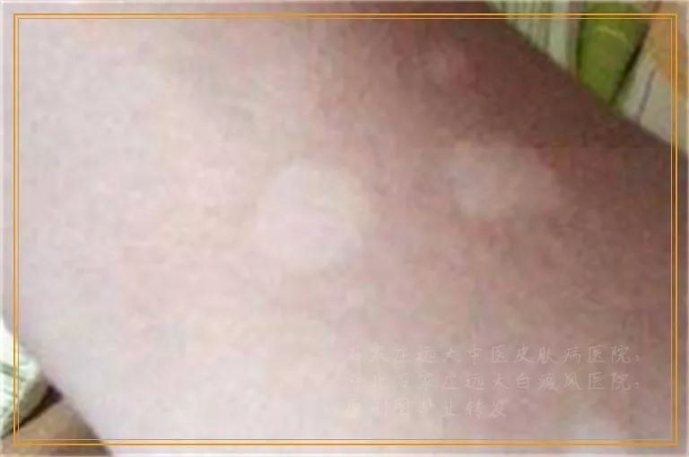 白癜风刚出现的时候是什么样子