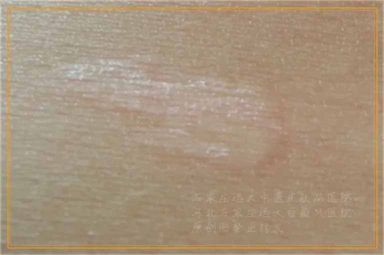 治疗脸上小白点做什么检查比较好