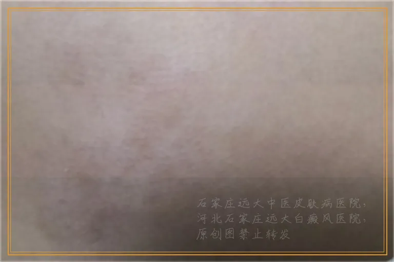 脸上出现几个白点怎么回事