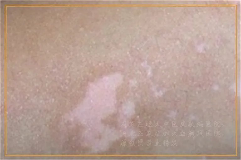 腿上出现好多白点是什么