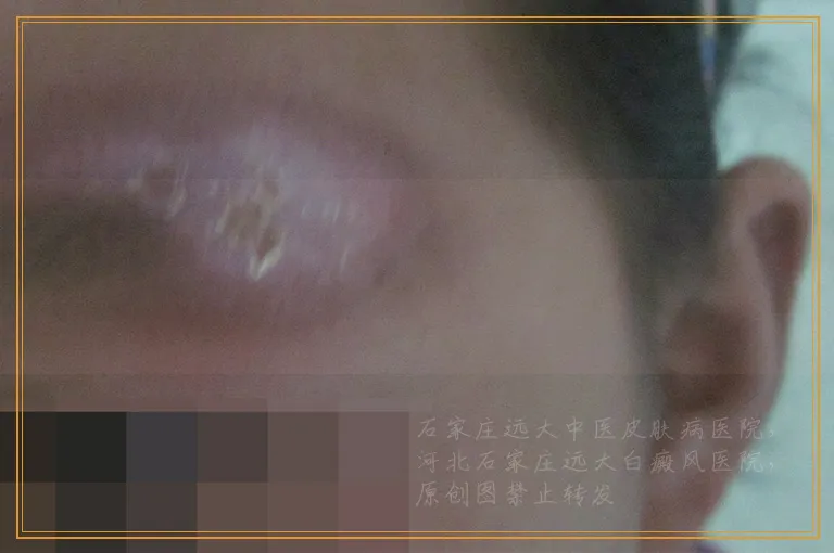 白癜风出现耐光性能停止一段时间在照光吗