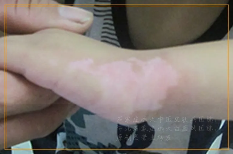 腿上出现许多白色的点点怎么回事