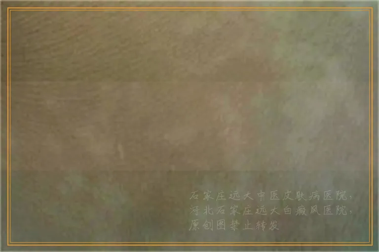 手掌有小白点还越来越多怎么办