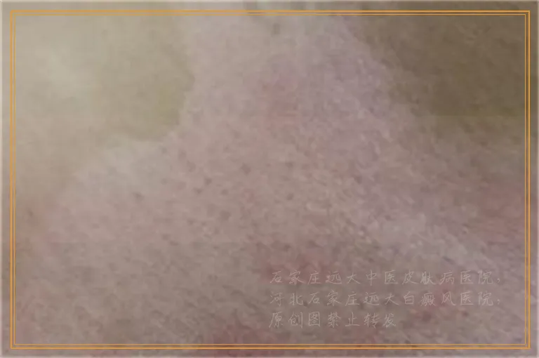 一岁宝宝腿上有一块白是什么