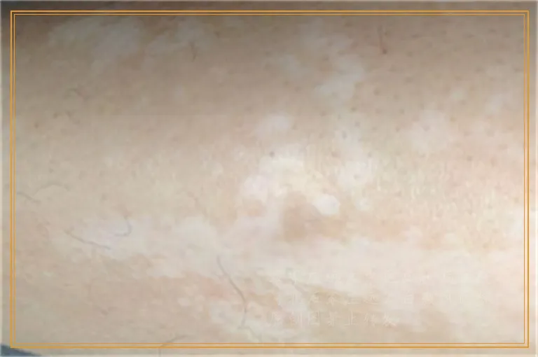 光疗照射白癜风后出现红肿发疼怎么回事