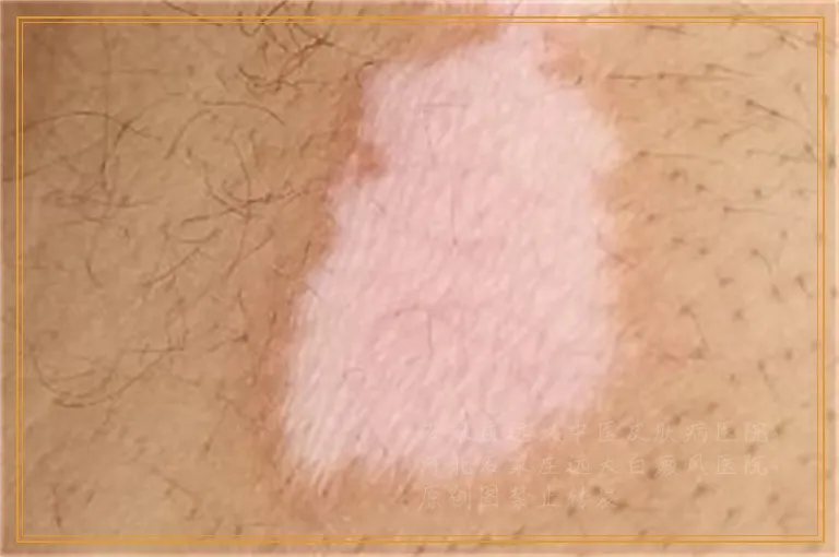 胸口位置出现了一些小白点是什么