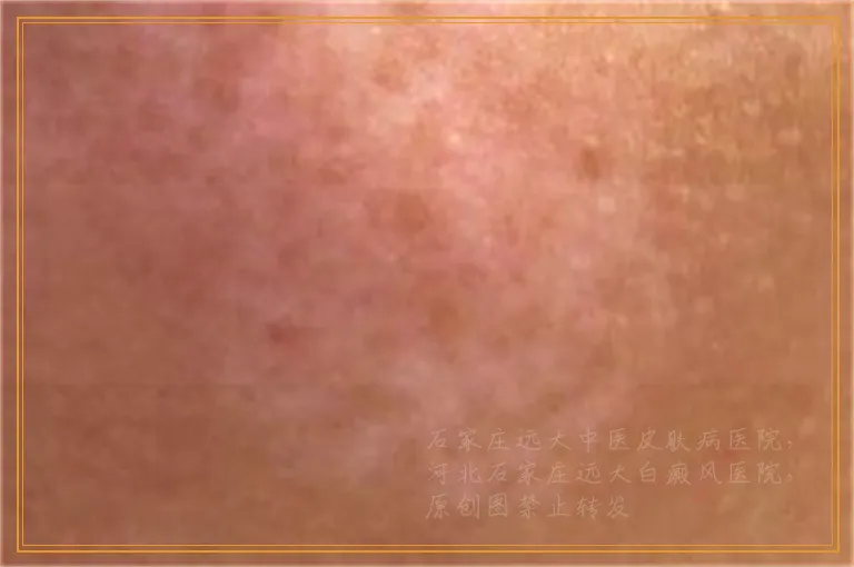 大腿根有一块白斑是不是白癜风