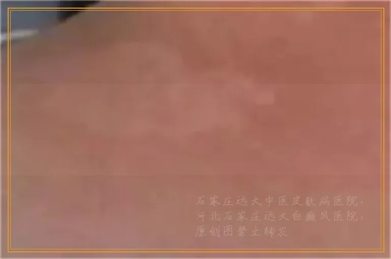 孩子脸上有小白点是什么原因