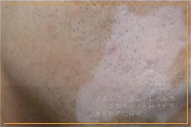 腿上好多小白点怎么判断是什么病