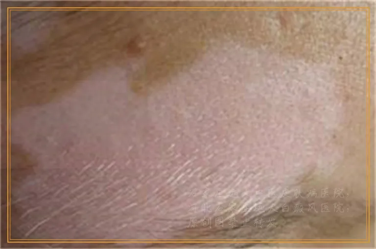 外伤掉痂后出现白斑还变大怎么办