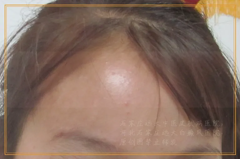 身体出现白斑别大意，可能是白癜风!