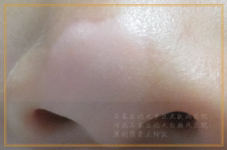 眼睛下边长一块白斑是什么病