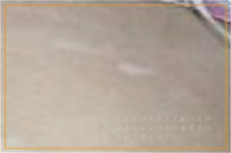 额头起花生仁大小白斑怎么办