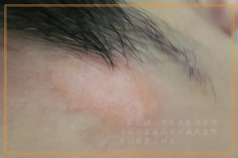 20岁女孩耳朵长白斑怎么回事