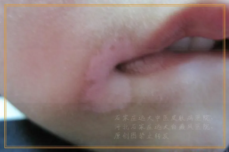 发展期间白癜风的症状图片是什么样的