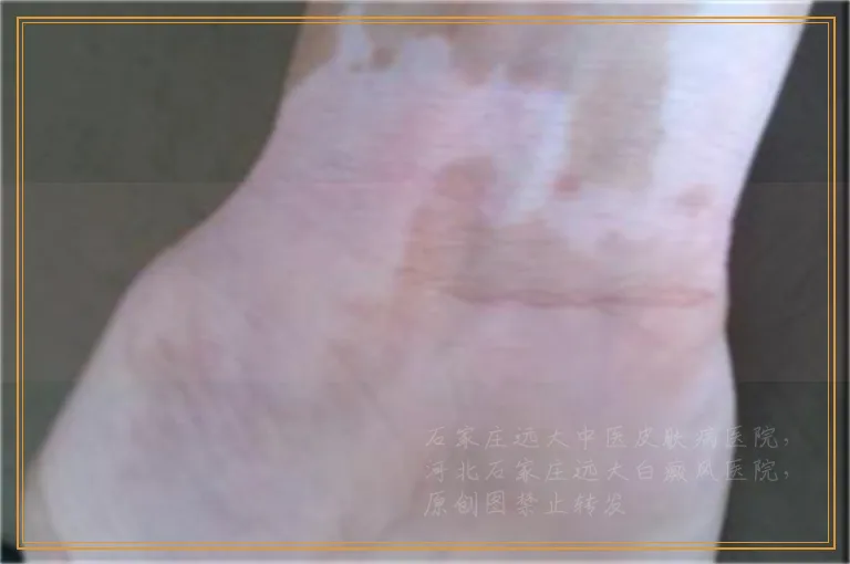 白癜风除了皮肤变白还有哪些症状