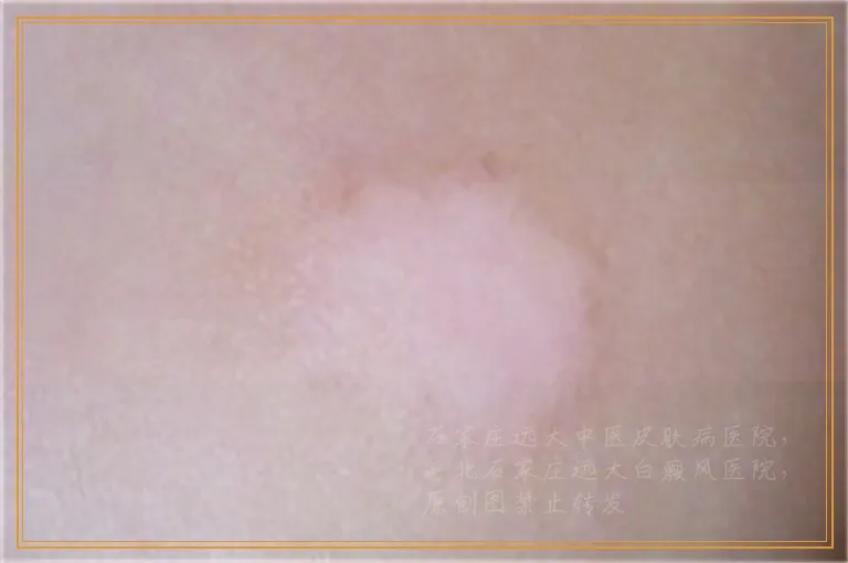 脸上白癜风越来越多是怎么回事