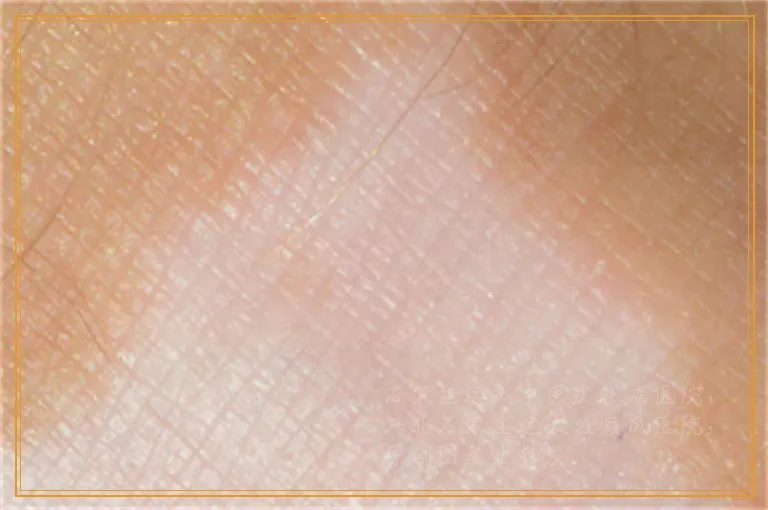 手腕长白斑像是白癜风怎么办