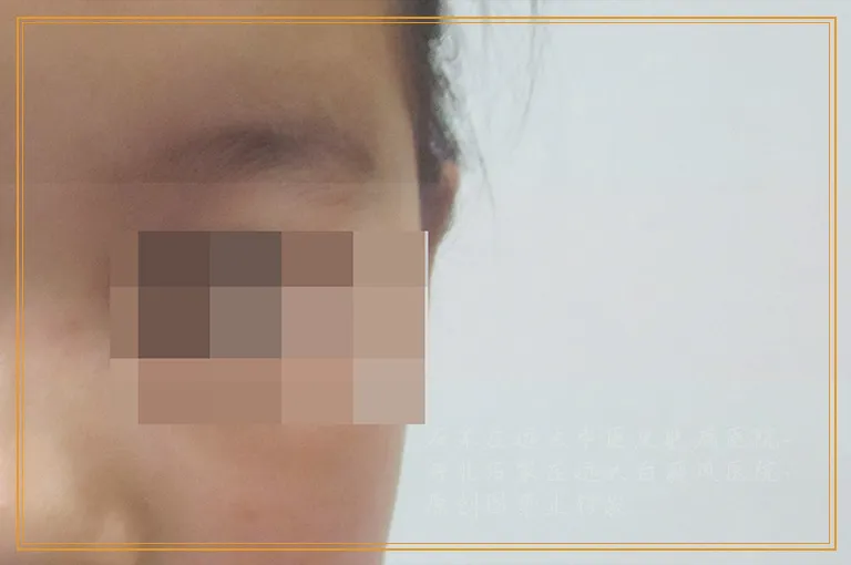 手指白斑初期症状图片