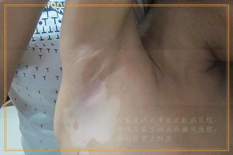 白癜风周围有很多的小红点是什么病