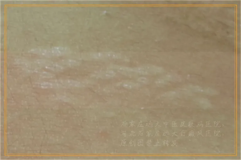 脸上白癜风有好转的症状是什么