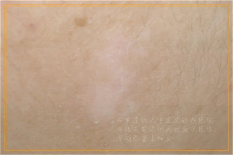 脸上出现了白癜风怎么治