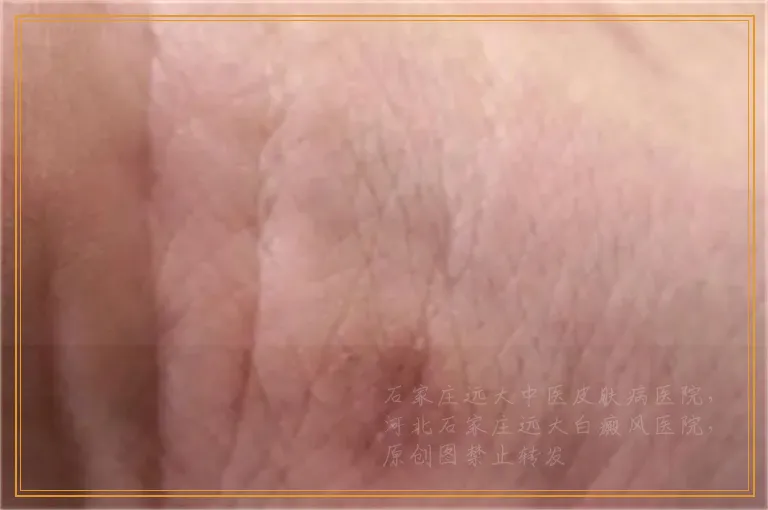 外伤血痂掉后有白斑是白癜风吗