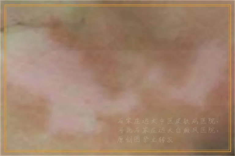 手背上一块块白斑是什么