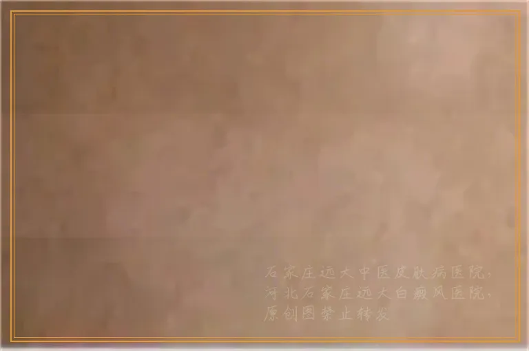 白癜风长在腿上的图片